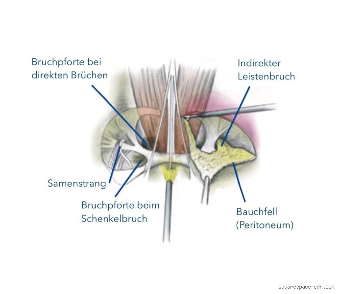 Welche Probleme nach Leistenbruch OP sind wirklich häufig und wie gehe ich damit um?