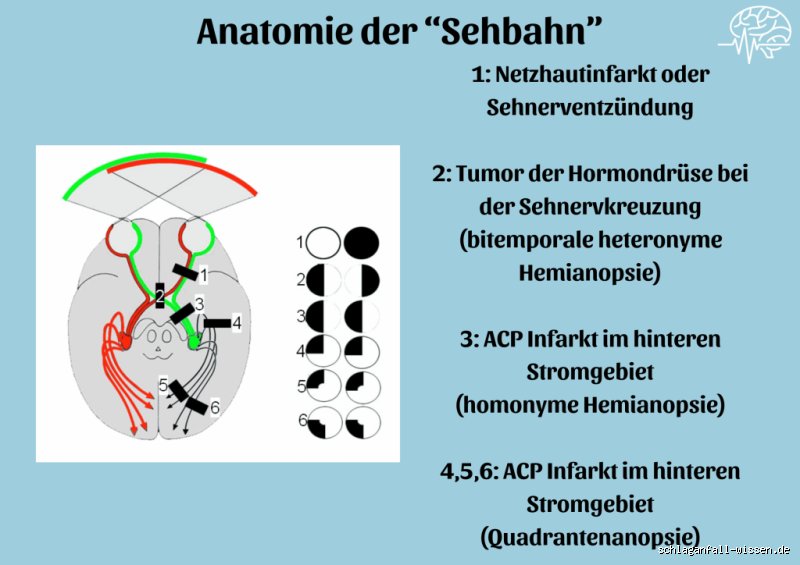 Welche Sehstörungen bei Tumor?