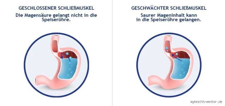 Welchen Tee nicht trinken bei Sodbrennen? Die kritische Auswahl für Reflux-Patienten