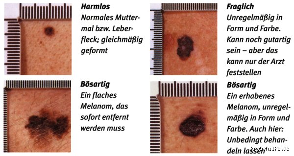 Welcher Hautkrebs ist tödlich?