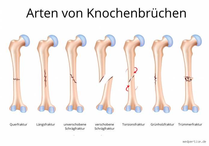 Welcher ist der häufigste Knochenbruch?