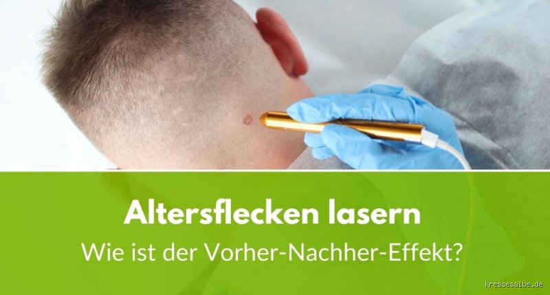 Welcher Laser für Altersflecken?
