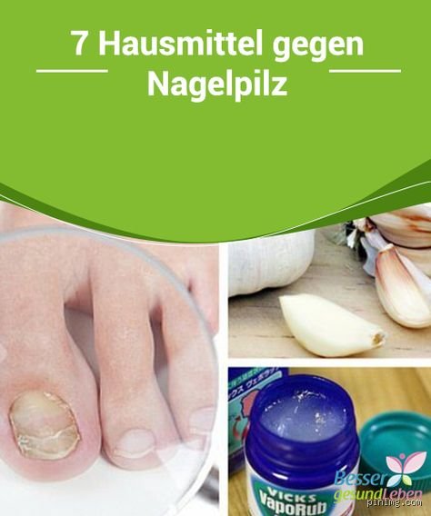 Welches Gewürz hilft bei Nagelpilz? Meine Erfahrungen mit Knoblauch als natürliche Hilfe