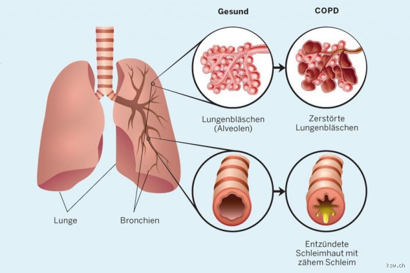 Welches Klima ist gut für COPD?
