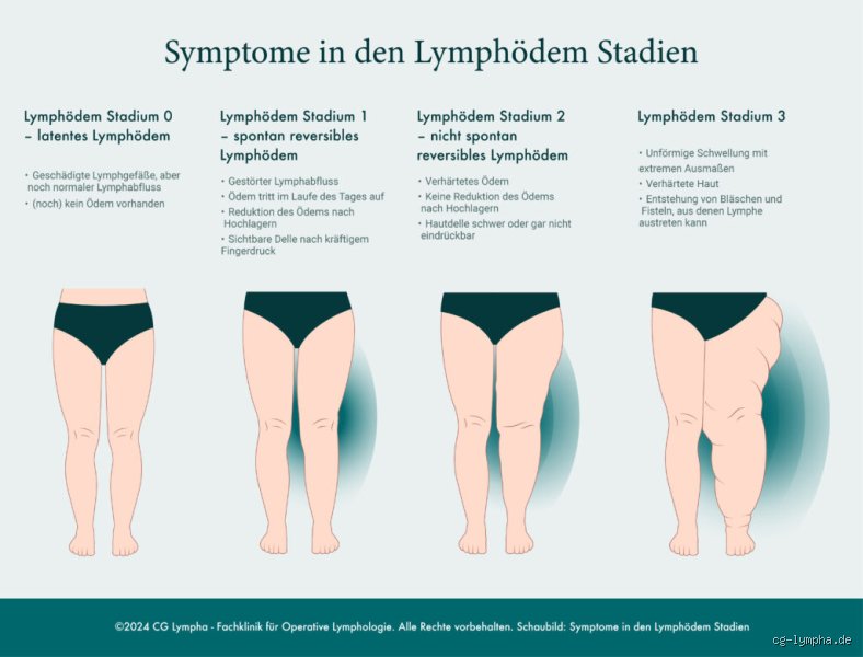 Wer bekommt Lymphödem? Eine ehrliche Erklärung aus meiner Sicht