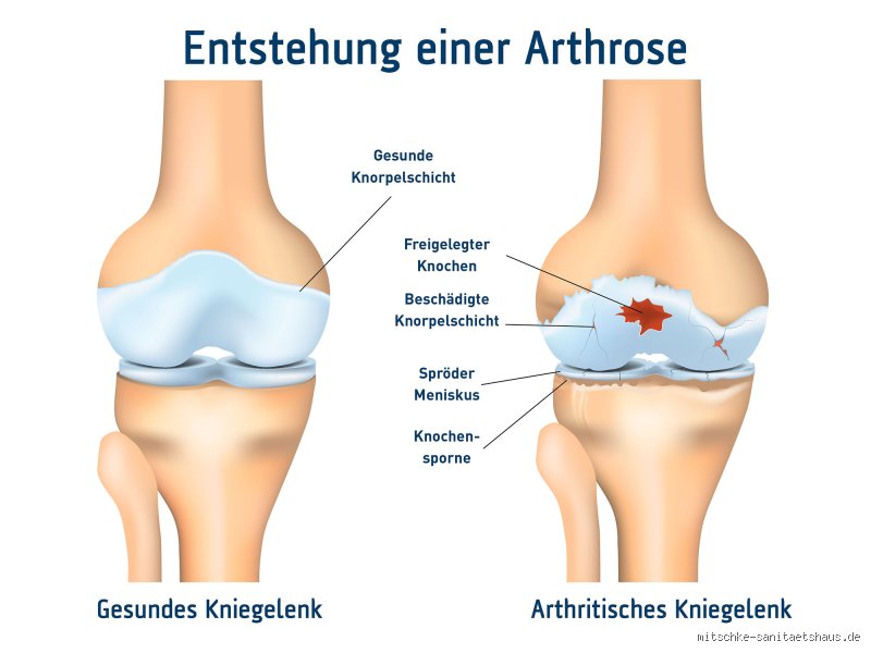 Wie äußert sich ein Arthroseschub?