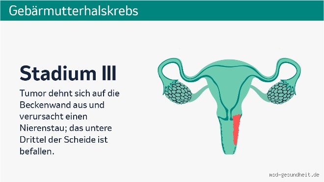 Wie beginnt Gebärmutterhalskrebs? Der Weg von der HPV-Infektion zur Krebserkrankung