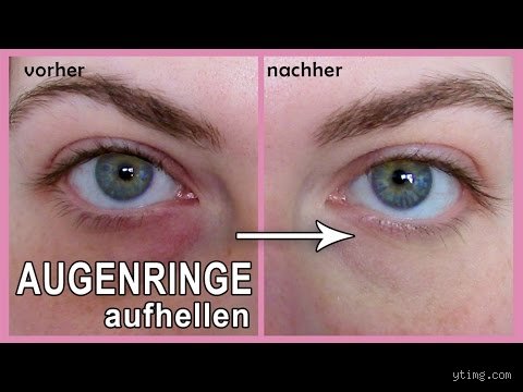 Wie bekomme ich schwarze Augenringe weg?