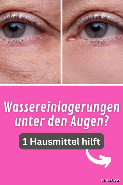 Wassereinlagerungen unter den Augen loswerden: Meine Erfahrungen und Tipps