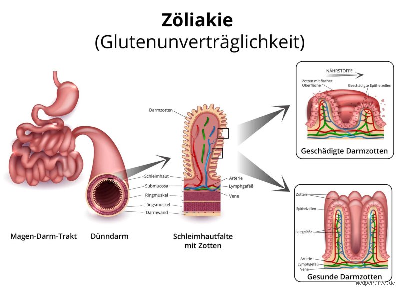 Wie bricht Zöliakie aus? Ursachen und Mechanismen der Glutenunverträglichkeit