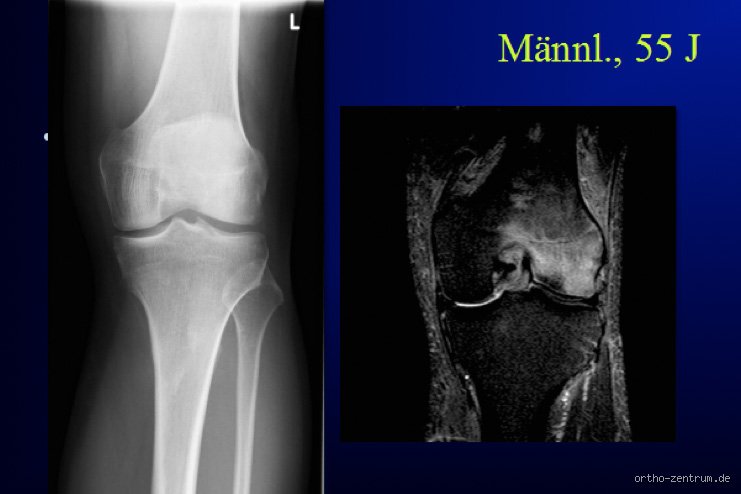 Wie erkennt man Arthrose auf dem MRT? Eine praktische Anleitung zur Diagnose