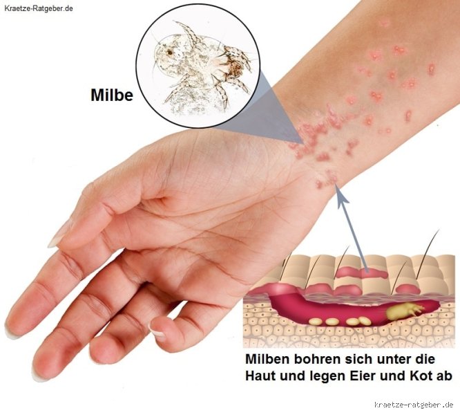Wie Erkennt Man Milben Unter Der Haut Wie Erkennt Man Milben Unter Der Haut
