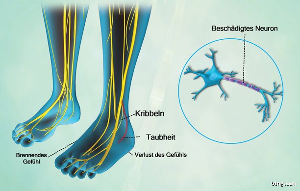 Wie beginnt Neuropathie? Die ersten Anzeichen und Ursachen verstehen