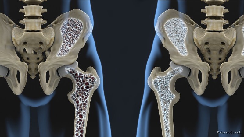 Wie fühlen sich Osteoporose Schmerzen an?