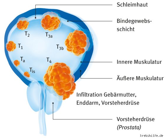 Wie kommt es zu Blasenkrebs?