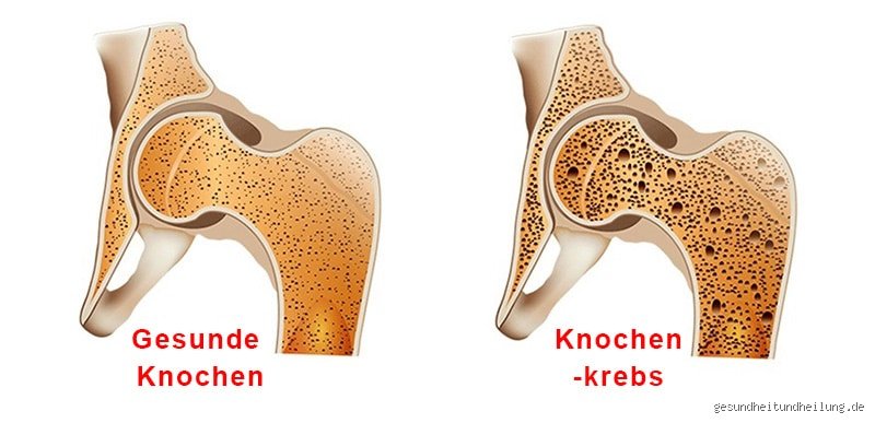 Wie kündigt sich Knochenkrebs an?