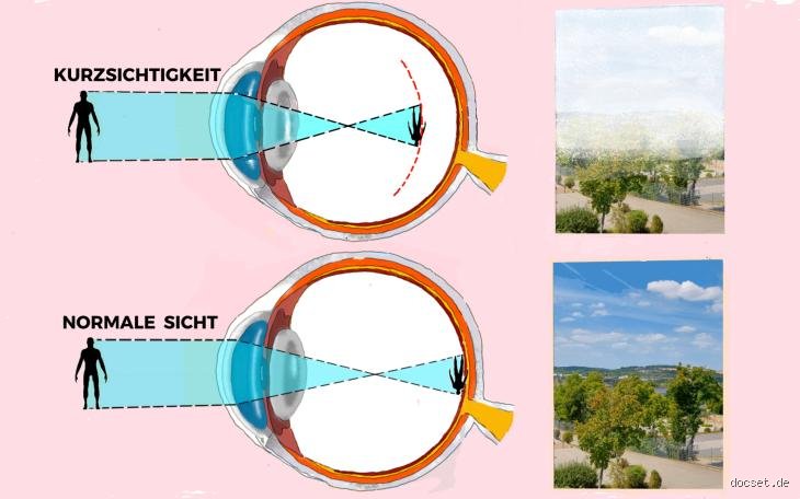 Wie Kurzsichtigkeit aufhalten?