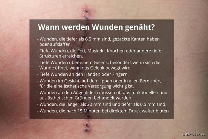 Wie lange darf eine genähte Wunde nicht nass werden?