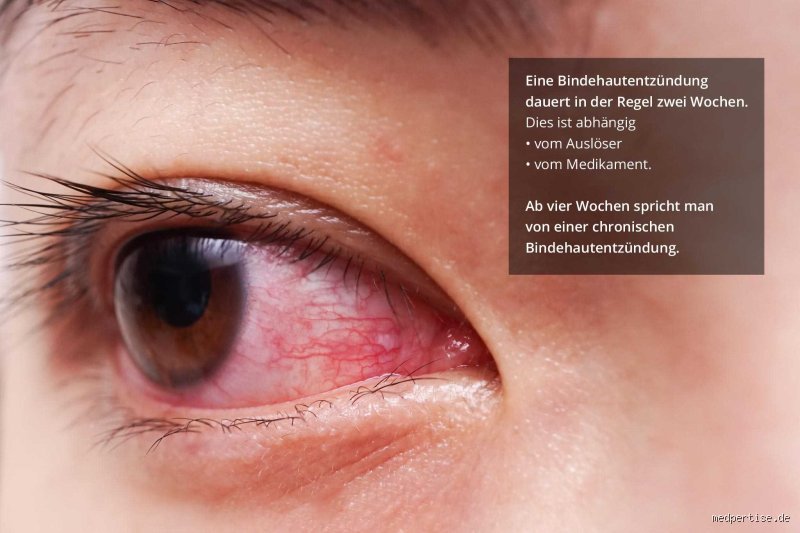 Wie lange dauert eine unbehandelte Bindehautentzündung wirklich?