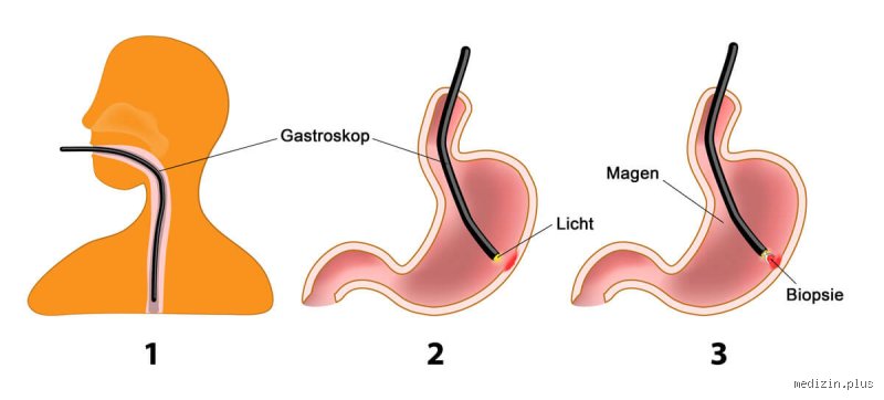Wie lange dauert es bis man nach einer Magenspiegelung wieder fit ist?