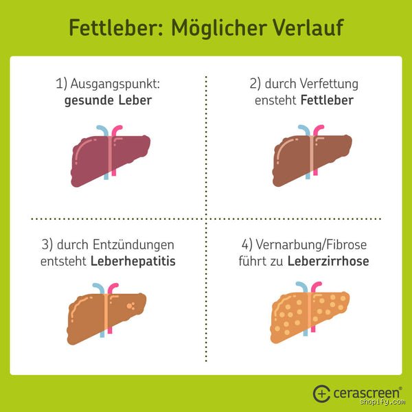 Wie lange dauert es von der Fettleber bis zur Leberzirrhose? Der schleichende Weg im Detail