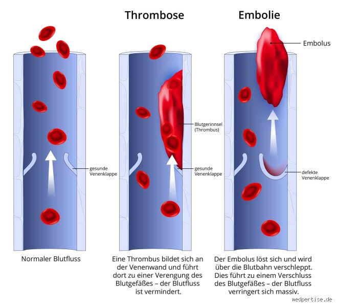 Wie lange dauert es von Thrombose zur Embolie?