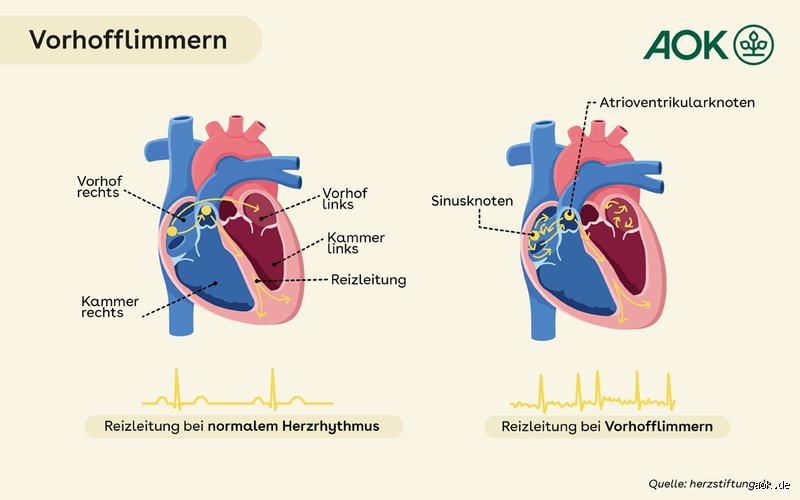 Wie lange Erholung nach Vorhofflimmern?