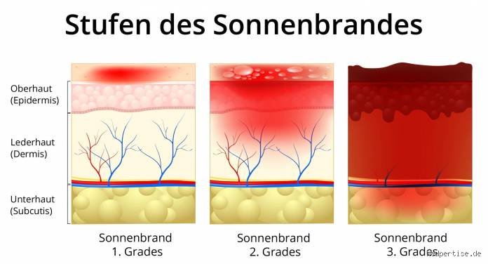 Wie lange ist ein Sonnenbrand rot?