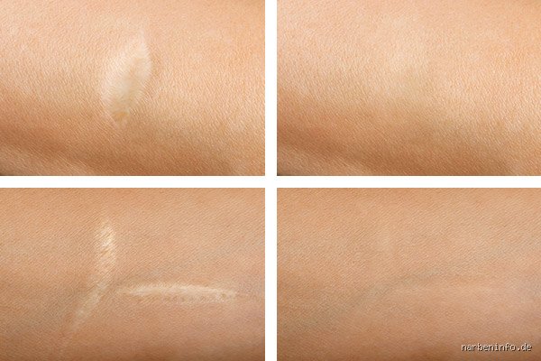Wie lange ist eine Narbe aktiv? Alles, was du wissen musst