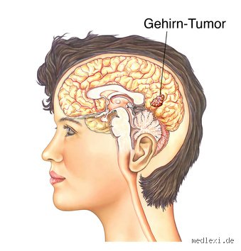Wie lange kann ein Hirntumor unbemerkt sein?