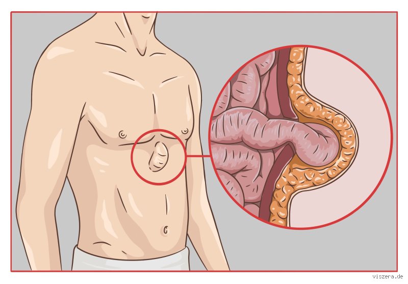 Wie lange krank nach Hernien OP?