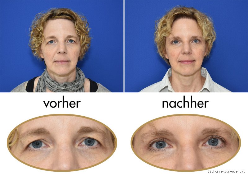 Wie lange krank nach Schlupflider OP?