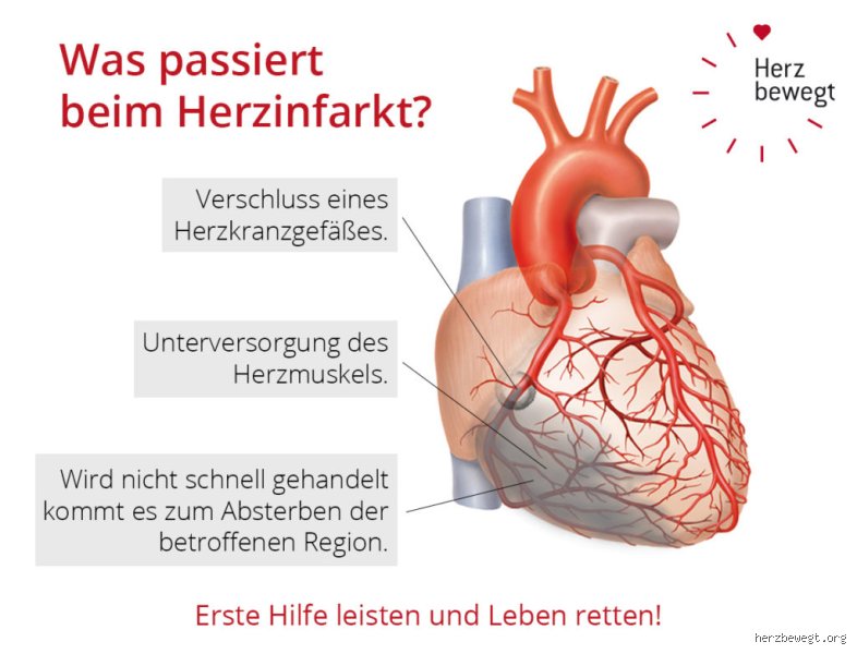Wie lange kündigt sich ein Herzinfarkt an?