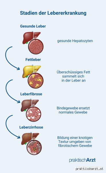 Wie lange lebe ich noch mit Leberzirrhose?