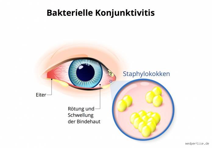 Wie machen sich Staphylokokken bemerkbar?
