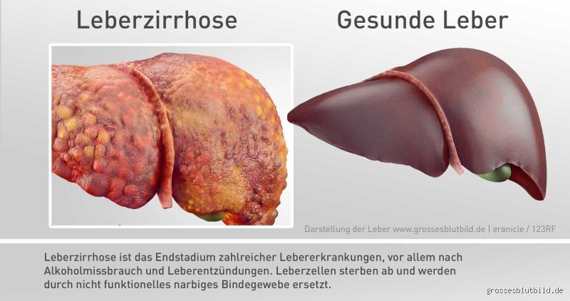 Wie merkt man, dass man Leberzirrhose hat? Frühe Anzeichen und was du wissen solltest