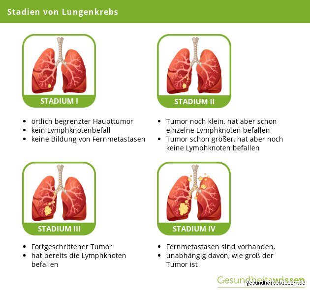Wie merkt man Lungenkrebs im Anfangsstadium?