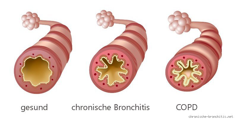Wie merkt man verengte Bronchien?