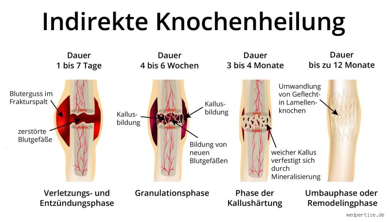 Wie schnell wächst ein Bruch zusammen – Der unterschätzte Heilungsprozess von Knochenbrüchen bei Mensch und Sportler