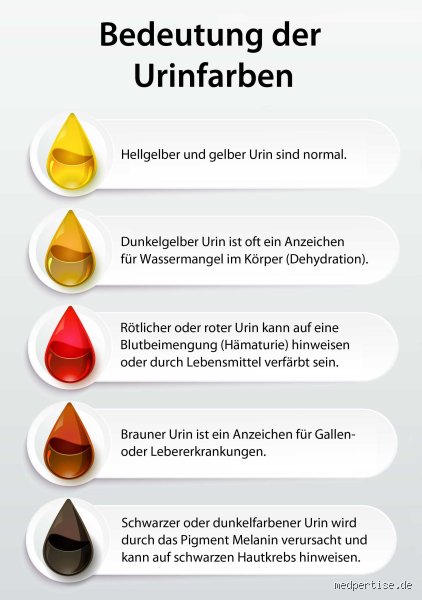 Wie sieht der Urin bei einer Leberzirrhose aus und was die Farbe verrät