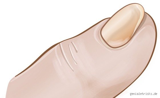 Wie sieht ein Löffelnagel genau aus? Die Form, die Symptome und was dahintersteckt