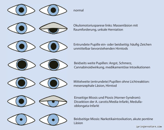 Wie sehen die Pupillen bei Hirndruck aus?