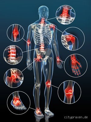 Wie stellt der Orthopäde Arthrose fest?
