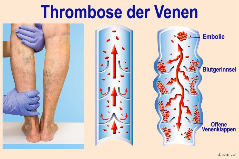 Wie überprüft man ob man Thrombose hat?