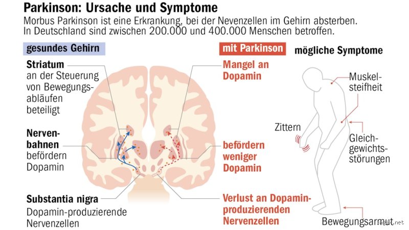 Wie verändert sich der Körper bei Parkinson?