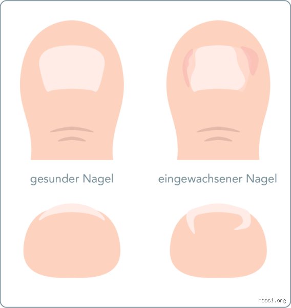 Wie viel wächst ein Fußnagel im Monat wirklich? Die überraschende Wahrheit über Zehennägel