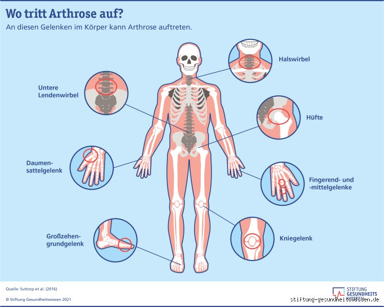 Wie viele Schritte pro Tag bei Arthrose? Die ehrliche Zahl, die Sie wirklich brauchen