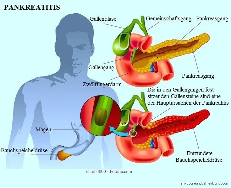 Wie wird eine Pankreatitis diagnostiziert?
