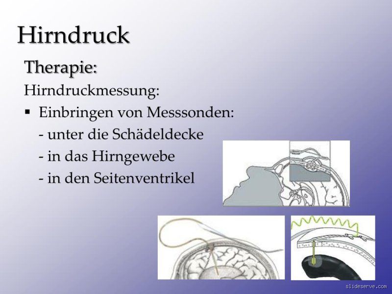 Wie wird Hirndruck gesenkt? Ein detaillierter Blick auf Therapie und Management