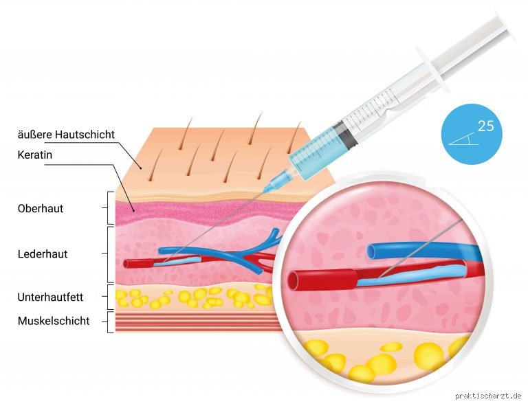 Wieso spritzt man in die Vene? Medizinische Hintergründe und Vorteile der intravenösen Applikation